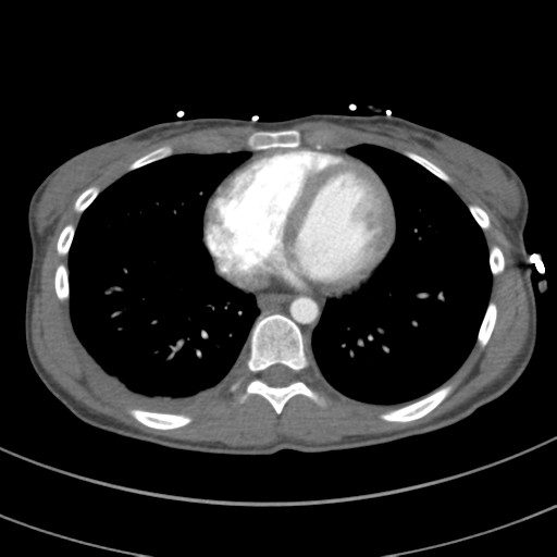 File:Abdominal multi-trauma - devascularised kidney and liver, spleen and pancreatic lacerations (Radiopaedia 34984-36486 Axial C+ arterial phase 58).png