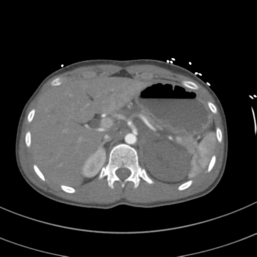 File:Abdominal multi-trauma - devascularised kidney and liver, spleen and pancreatic lacerations (Radiopaedia 34984-36486 Axial C+ arterial phase 91).png