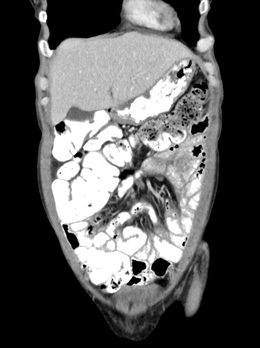 Abdominal wall and retroperitoneal tuberculosis (Radiopaedia 88137-104729 Coronal C+ portal venous phase 24).jpg