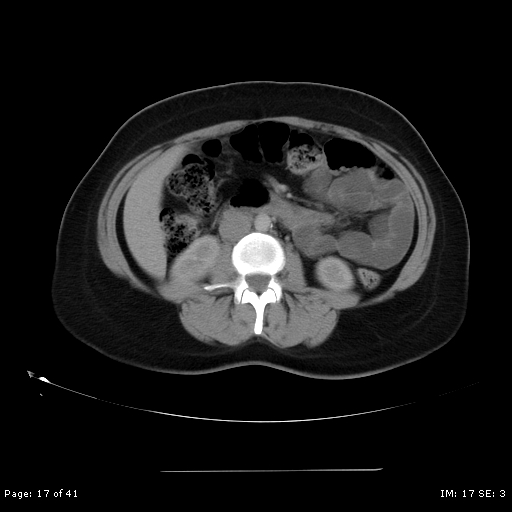 File:Abdominal wall endometriosis (Radiopaedia 25723-25885 Axial C+ portal venous phase 17).jpg