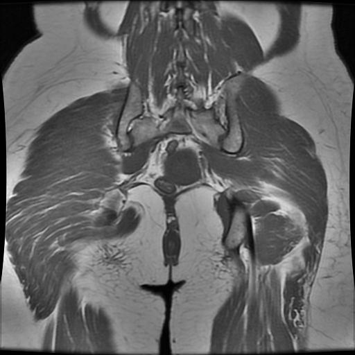 File:Abdominal wall endometriosis (Radiopaedia 83702-98847 Coronal T1 15).jpg