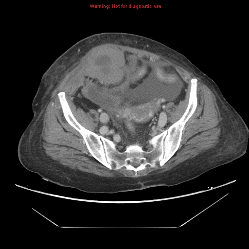 File:Abdominal wall hematoma (Radiopaedia 9427-10112 Axial C+ portal venous phase 85).jpg
