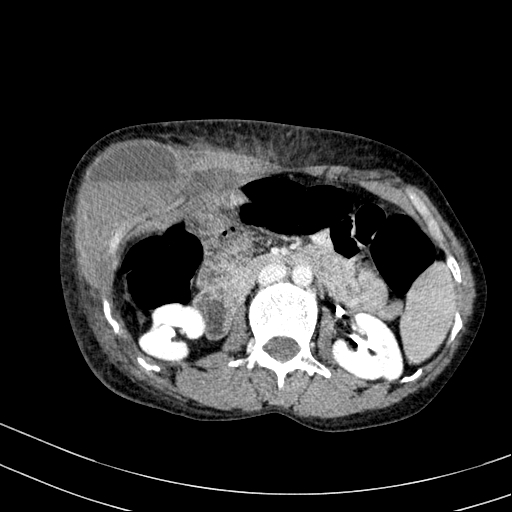 Abdominal wall hematoma with active bleeding (Radiopaedia 83915-99122 Axial contrast-enhanced CT 4).jpg