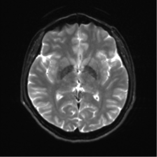 File:Abducens nerve palsy (Radiopaedia 51069-56648 Axial DWI 13).png
