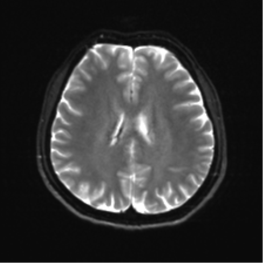 Abducens nerve palsy (Radiopaedia 51069-56648 Axial DWI 17).png