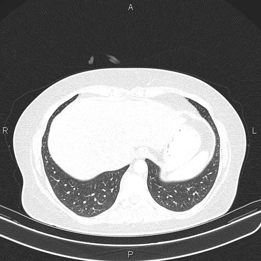 Aberrant right subclavian artery (Radiopaedia 87334-103629 Axial lung window 55).jpg