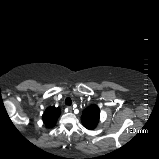 File:Aberrant right subclavian artery stenosis (Radiopaedia 52656-58670 Axial C+ arterial phase 10).jpg