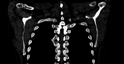 Accesory rib joint (Radiopaedia 71987-82452 Coronal bone window 58).jpg