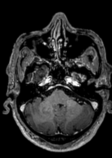 Accessory middle cerebral artery (Radiopaedia 73114-83828 Axial T1 C+ 133).jpg