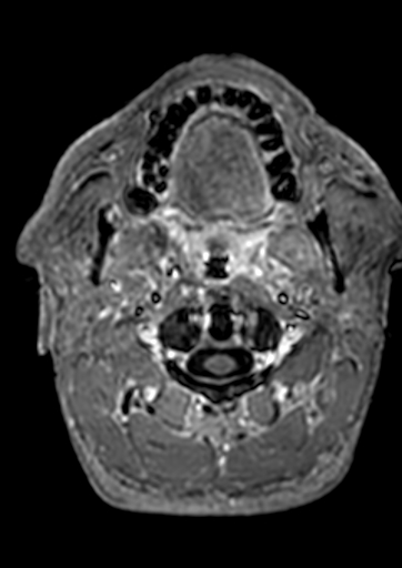 Accessory middle cerebral artery (Radiopaedia 73114-83828 Axial T1 C+ 226).jpg