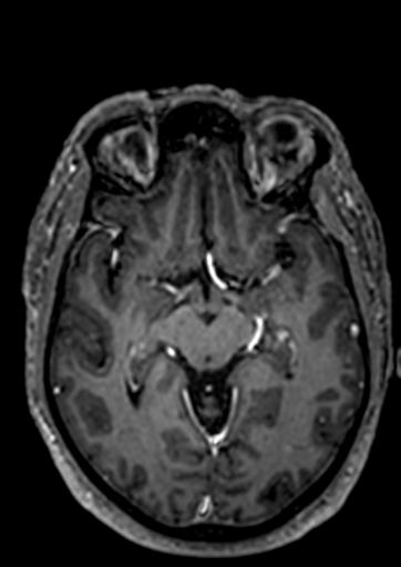 File:Accessory middle cerebral artery (Radiopaedia 73114-83828 Axial T1 C+ 61).jpg