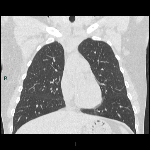 Accidental foreign body aspiration (seamstress needle) (Radiopaedia 77740-89983 Coronal lung window 40).jpg