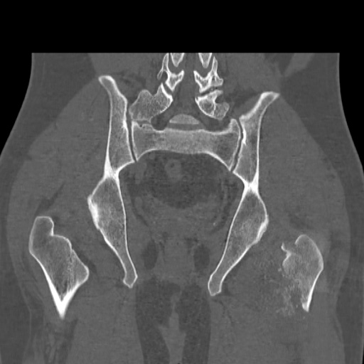 Acetabular and ilial fractures (Radiopaedia 59084-66378 Coronal bone window 36).jpg