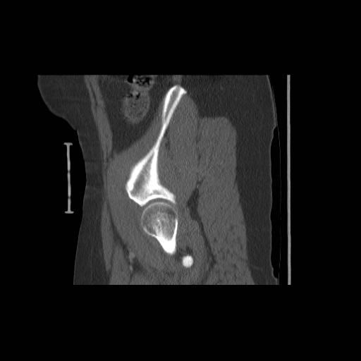 File:Acetabular fracture (Radiopaedia 13193-13212 Sagittal bone window 17).jpg