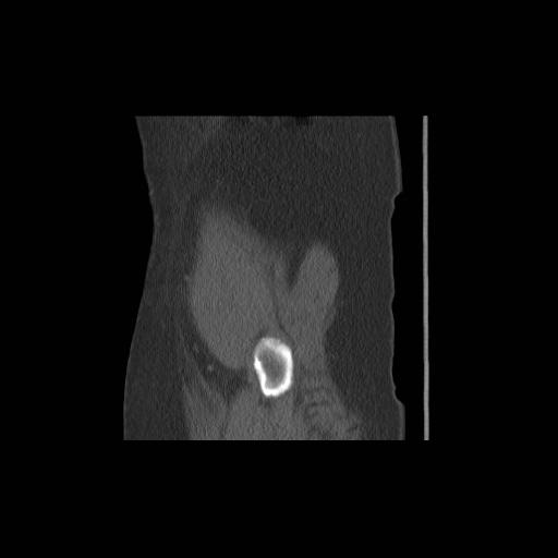 File:Acetabular fracture (Radiopaedia 13193-13212 Sagittal bone window 3).jpg