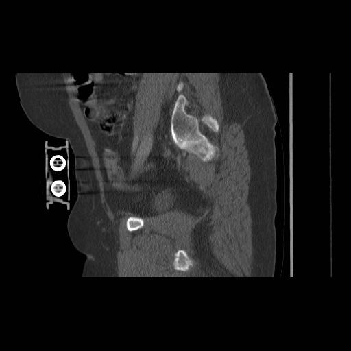 File:Acetabular fracture (Radiopaedia 13193-13212 Sagittal bone window 33).jpg