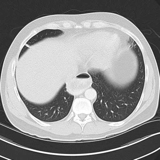 File:Achalasia of the cardia (Radiopaedia 38497-40595 Axial lung window 41).png