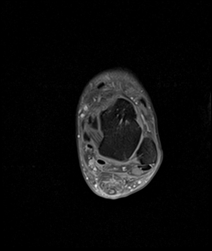 File:Achilles tendon tear (Radiopaedia 77615-89819 Axial PD fat sat 14).jpg