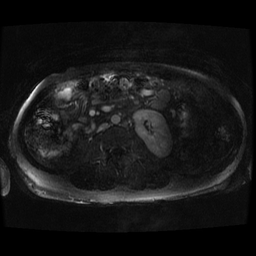 Acinar cell carcinoma of the pancreas (Radiopaedia 75442-86668 Axial T1 C+ fat sat 11).jpg