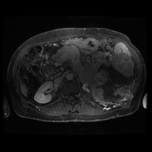 File:Acinar cell carcinoma of the pancreas (Radiopaedia 75442-86668 Axial T1 C+ fat sat 49).jpg