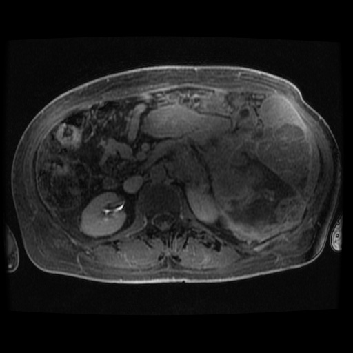 Acinar cell carcinoma of the pancreas (Radiopaedia 75442-86668 Axial late phase (~30 mins) 40).jpg