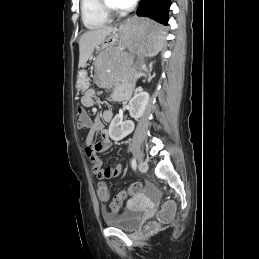 Acinar cell carcinoma of the pancreas (Radiopaedia 75442-86669 Sagittal C+ portal venous phase 114).jpg