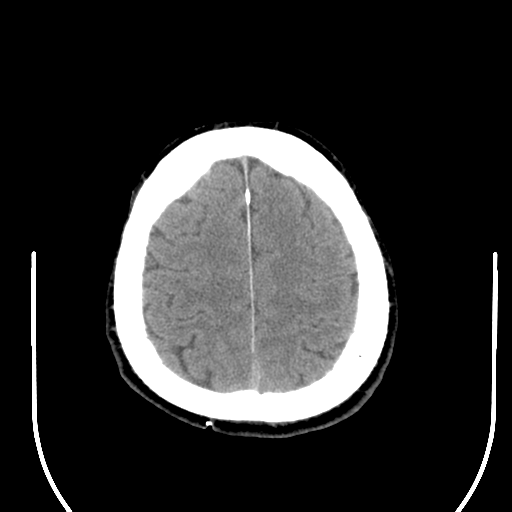 File:Acoustic schwannoma (Radiopaedia 39170-41388 Axial non-contrast 41).png