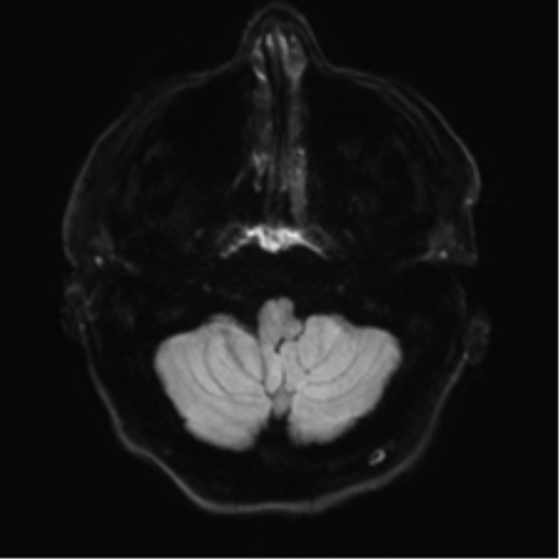 Acoustic schwannoma (Radiopaedia 50846-56358 Axial DWI 31).png