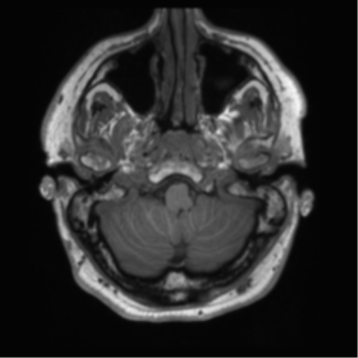 File:Acoustic schwannoma (Radiopaedia 50846-56358 Axial T1 5).png