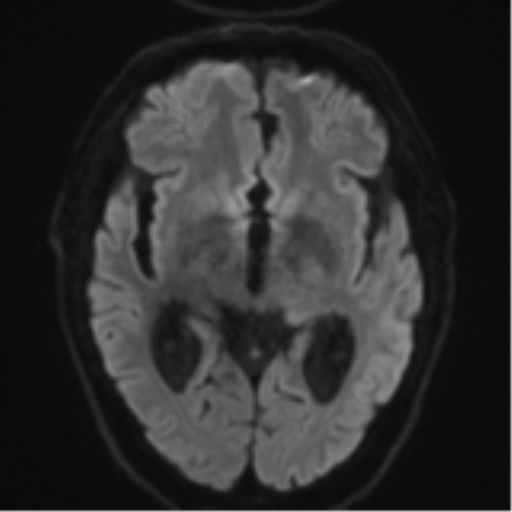 Acoustic schwannoma (Radiopaedia 55729-62281 E 39).png