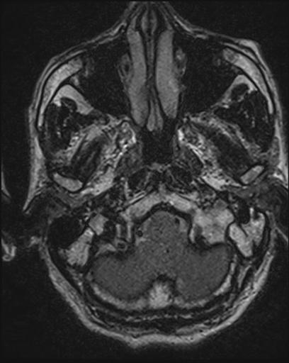 Acoustic schwannoma - probable (Radiopaedia 20386-20292 Axial T1 19).jpg