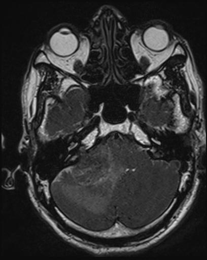 Acoustic schwannoma - probable (Radiopaedia 20386-20292 Axial T1 34).jpg