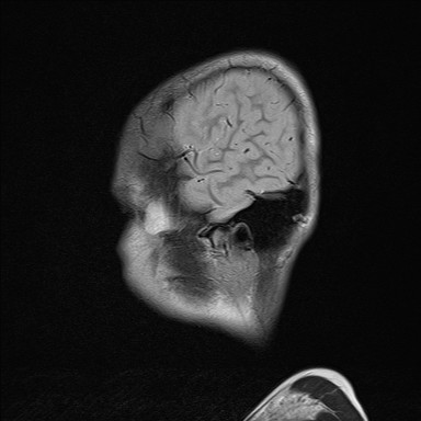 File:Acquired cerebellar tonsillar ectopia (Radiopaedia 39950-42423 Sagittal T2 1).jpg