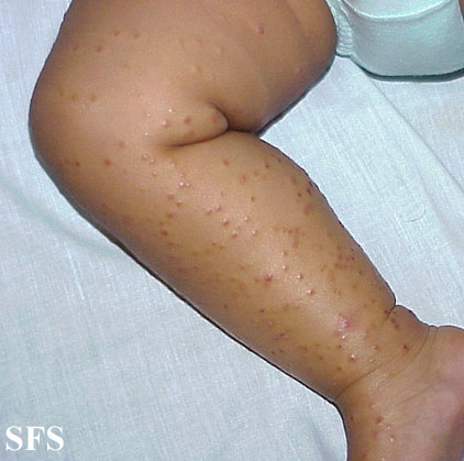 File:Acrodermatitis Infantile Papular (Dermatology Atlas 11).jpg