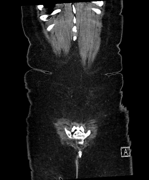 Active Crohn disease (Radiopaedia 59394-66750 Coronal C+ portal venous phase 65).jpg