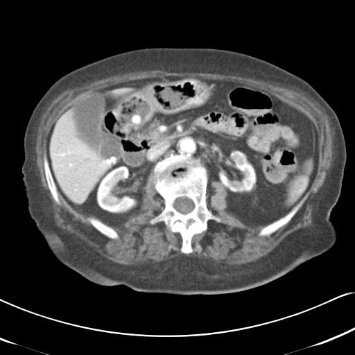 File:Active bleeding from duodenal ulcer with embolization (Radiopaedia 34216-35481 C 24).png