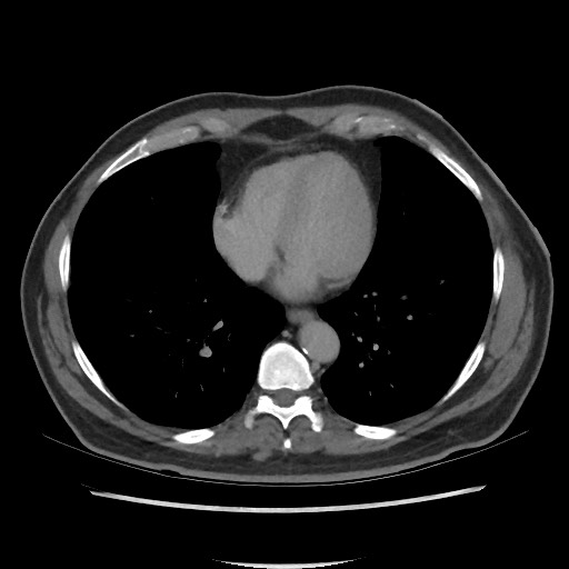 File:Active colonic bleed on CT (Radiopaedia 49765-55025 Axial C+ delayed 3).jpg