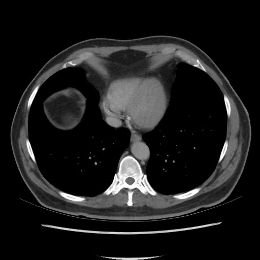 File:Active colonic bleed on CT (Radiopaedia 49765-55025 Axial C+ delayed 6).jpg