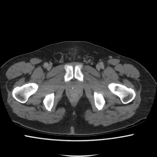 File:Active colonic bleed on CT (Radiopaedia 49765-55025 Axial C+ delayed 85).jpg