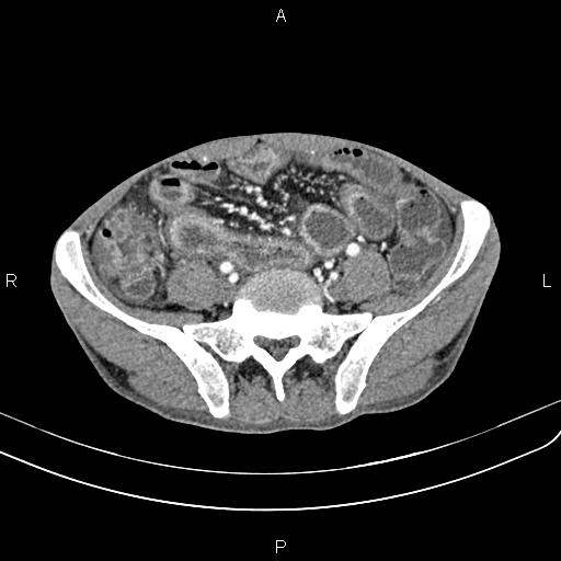 Active crohn disease (Radiopaedia 87133-103397 Axial C+ arterial phase 74).jpg