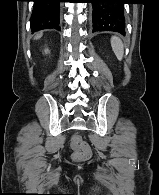 Active lower gastrointestinal bleeding - diverticular (Radiopaedia 61203-69106 Coronal C+ portal venous phase 108).jpg