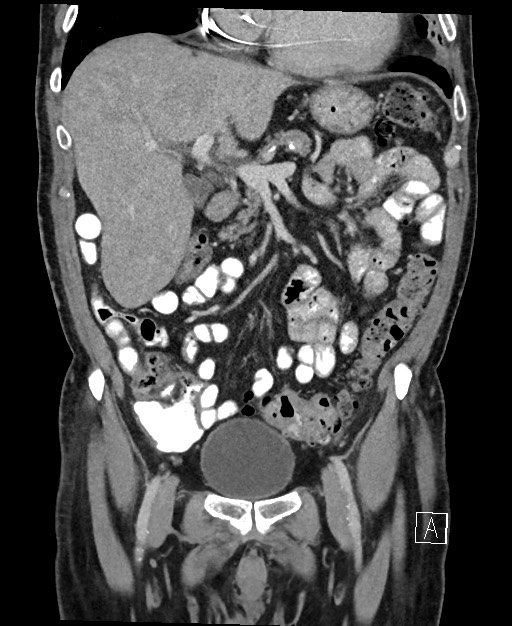Active lower gastrointestinal bleeding - diverticular (Radiopaedia 61203-69106 Coronal C+ portal venous phase 53).jpg