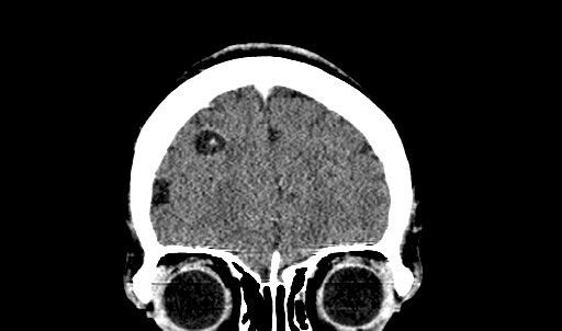 File:Active neurocysticercosis before and after therapy (Radiopaedia 71710-82099 Coronal 53).jpg