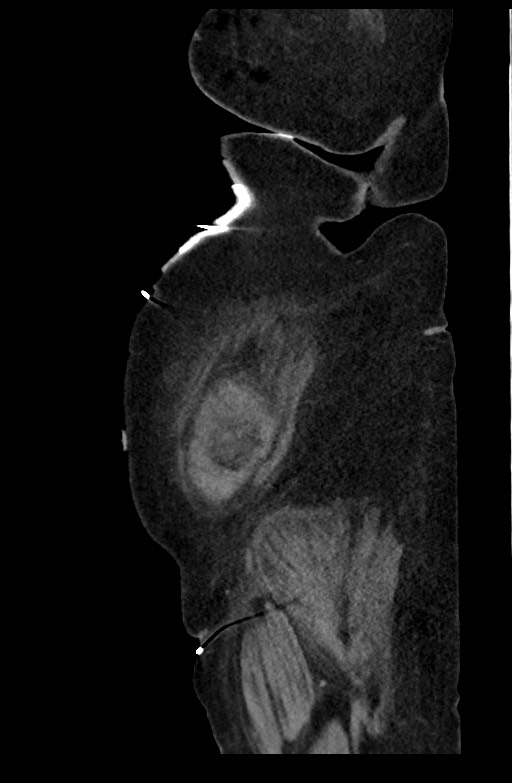 Active renal extravasation with large subcapsular and retroperitoneal hemorrhage (Radiopaedia 60975-68796 Sagittal C+ portal venous phase 37).jpg