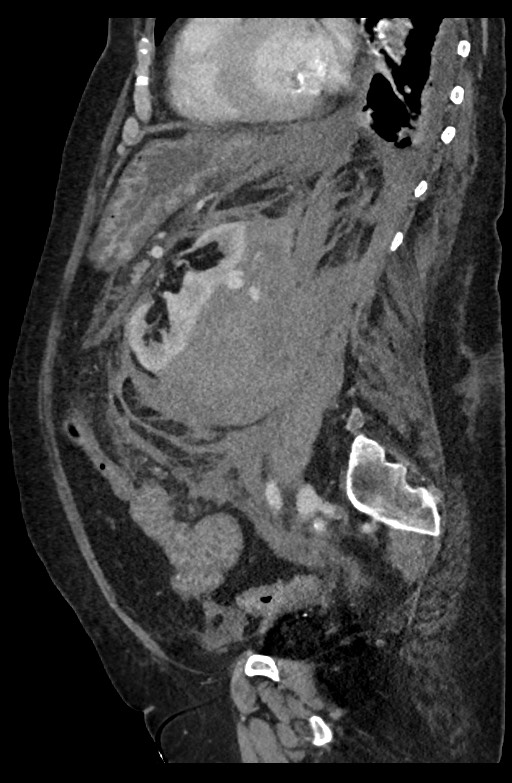 Active renal extravasation with large subcapsular and retroperitoneal hemorrhage (Radiopaedia 60975-68796 Sagittal C+ portal venous phase 94).jpg