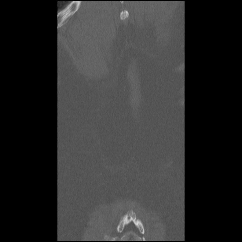 Acute Schmorl's node (Radiopaedia 83276-102365 Coronal bone window 60).jpg