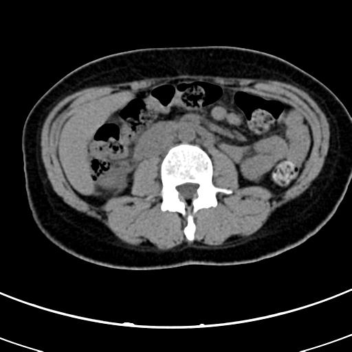 Acute appendicitis (Radiopaedia 30261-30888 Axial non-contrast 36).jpg