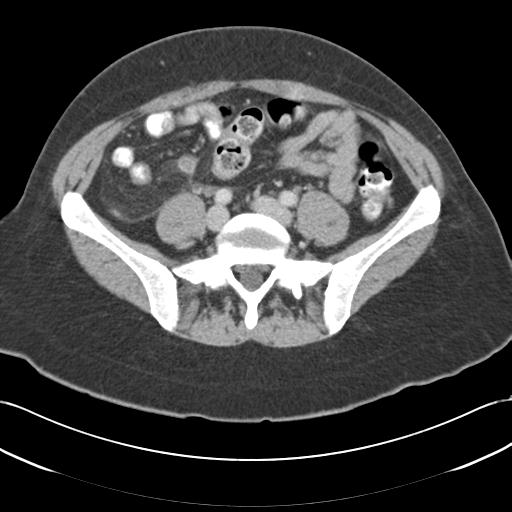 Acute appendicitis (Radiopaedia 30297-30934 Axial C+ portal venous phase 56).jpg