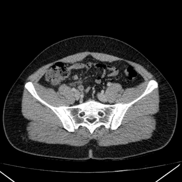 Acute appendicitis (Radiopaedia 38255-40270 Axial C+ portal venous phase 82).jpg