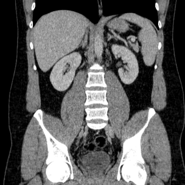 Acute appendicitis (Radiopaedia 38255-40270 Coronal C+ portal venous phase 52).jpg